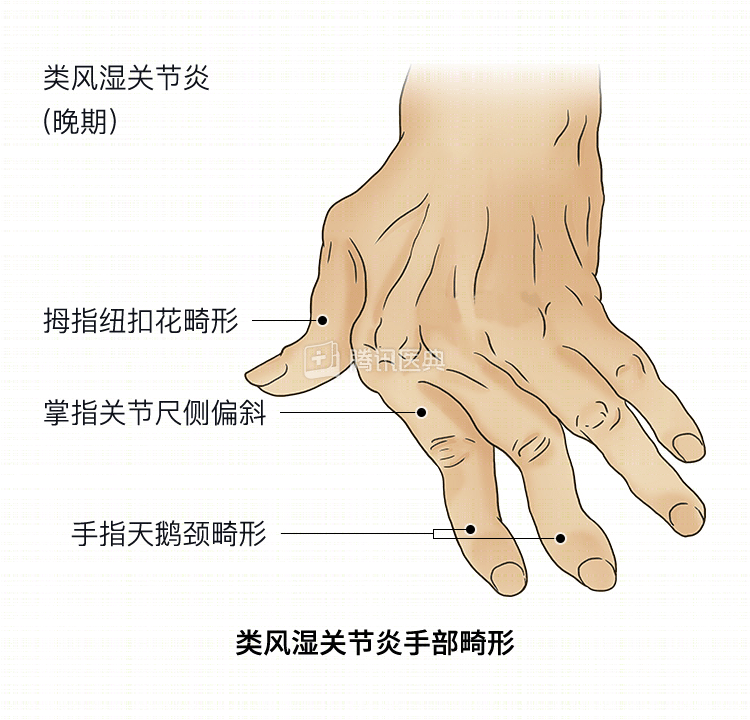 类风湿关节炎-中国.png