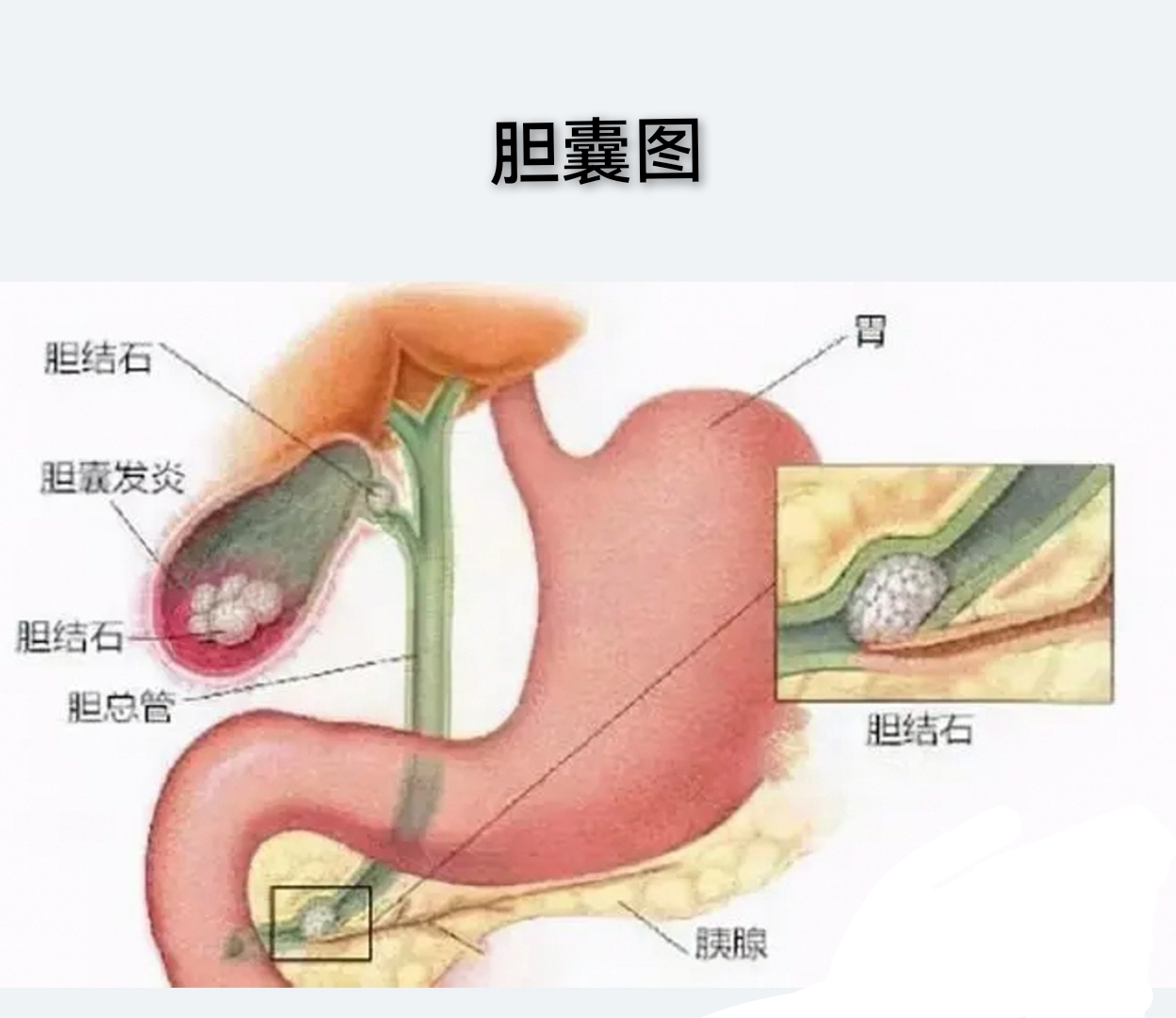 胆囊图.jpg