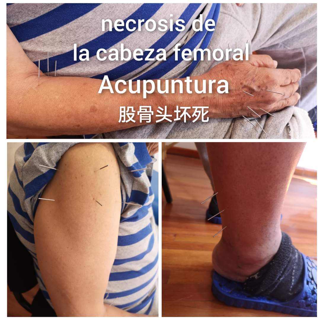 股骨头坏死.jpg