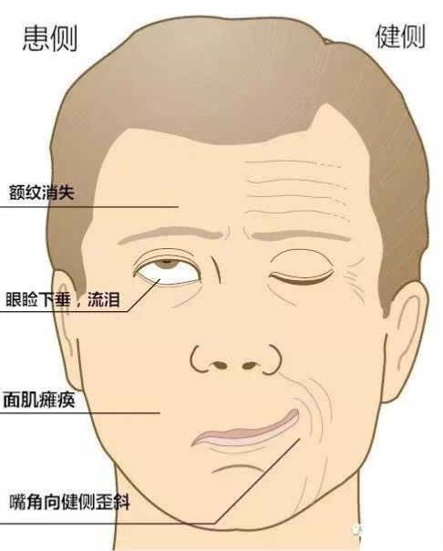 面瘫图.jpg