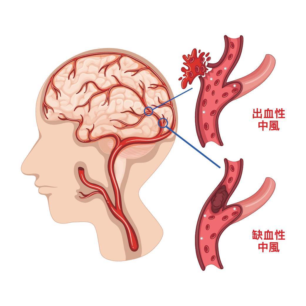 中风1.jpg