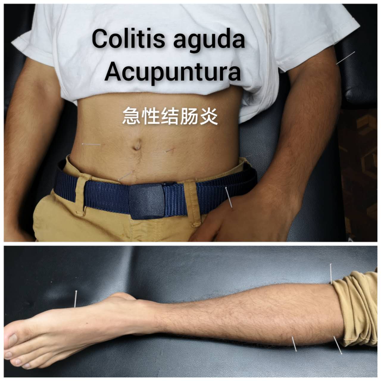 急性结肠炎.jpg