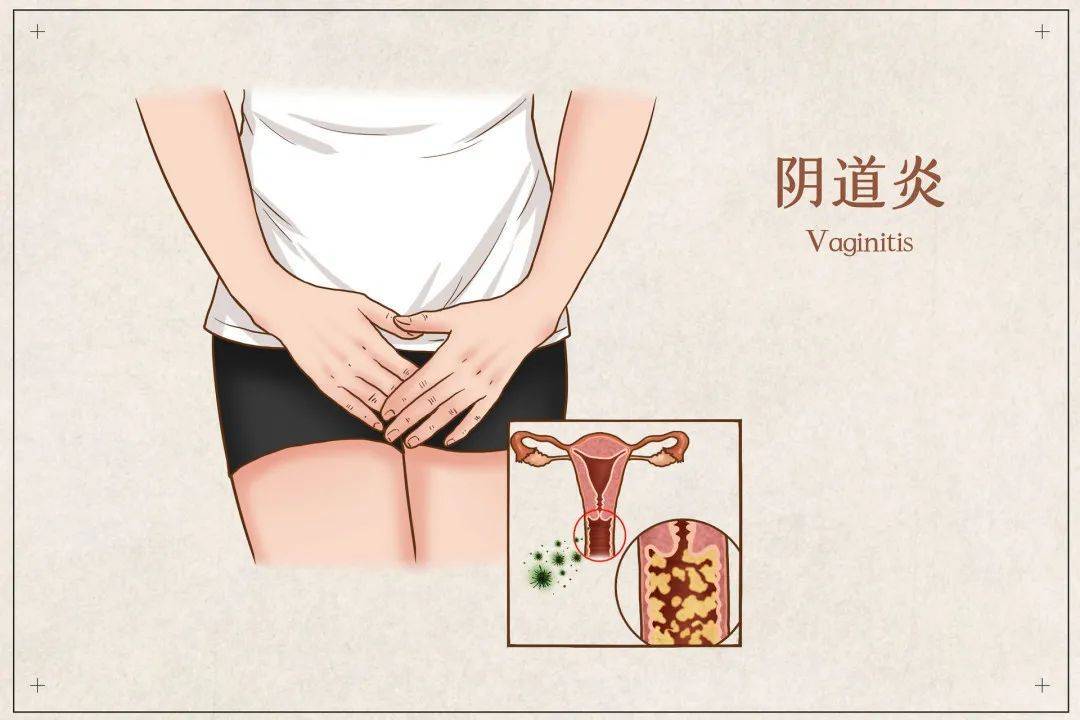 阴道炎图0.jpg