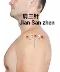 肩三针1.jpg