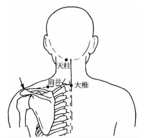 图3-1-1 最常见的压痛点（天柱穴与肩井穴）.png