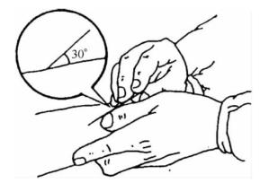 图2-2-7 针尖刺入皮肤时针体与皮肤呈30°角.png