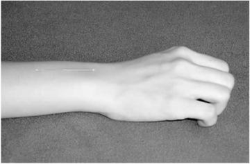图2-2-8 针尖刺至皮下放开手指时针体卧倒于皮肤表面（正确）.png
