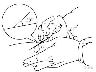 图1-6 腕踝针进针法.png