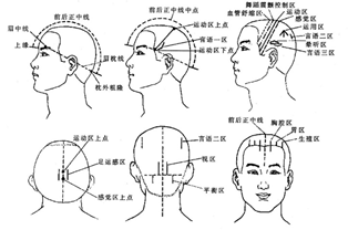 头针疗法图.png