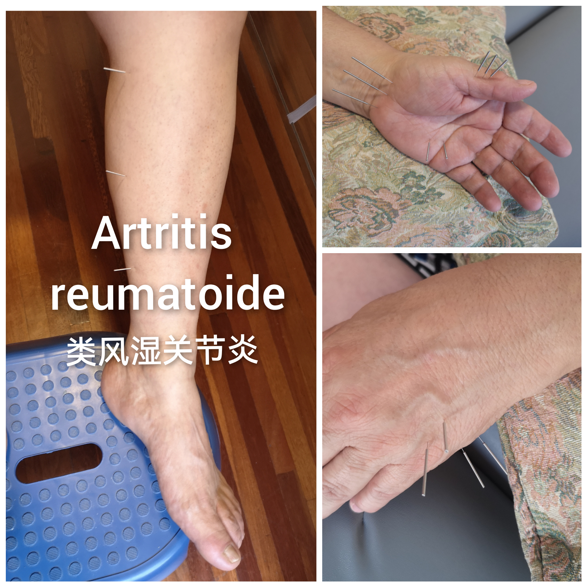 类风湿关节炎.jpg