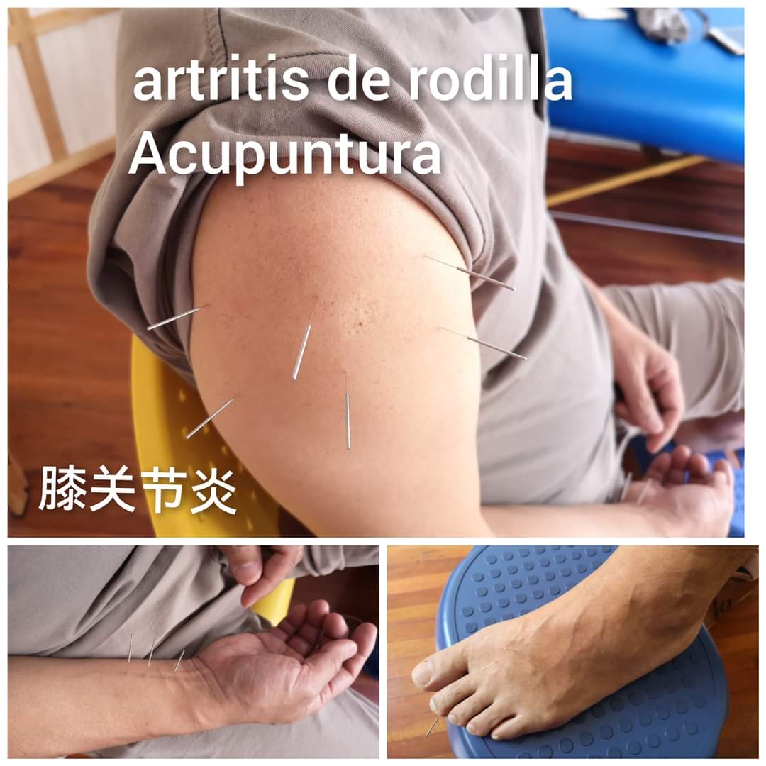 膝关节炎.jpg