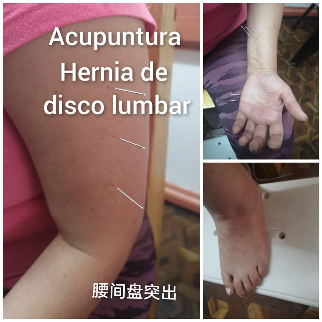 腰间盘突出.jpg