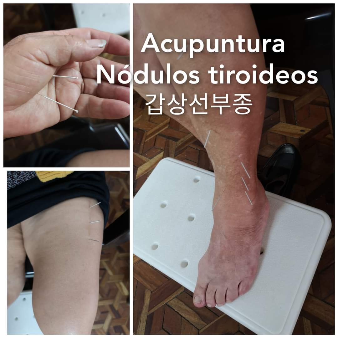 甲状腺亢进.jpg