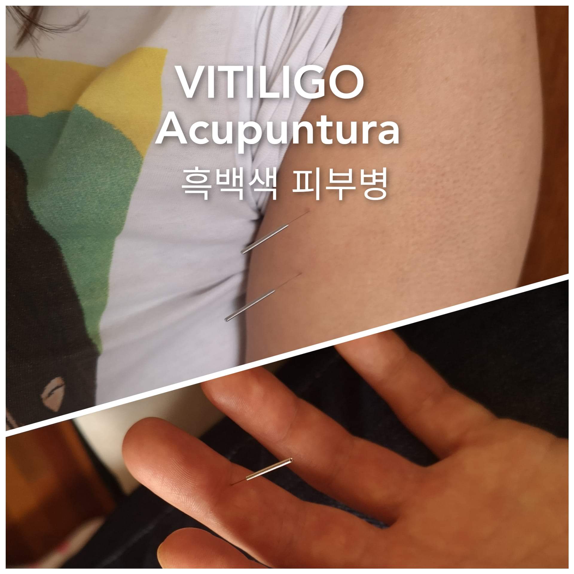 黑白皮肤病.jpg