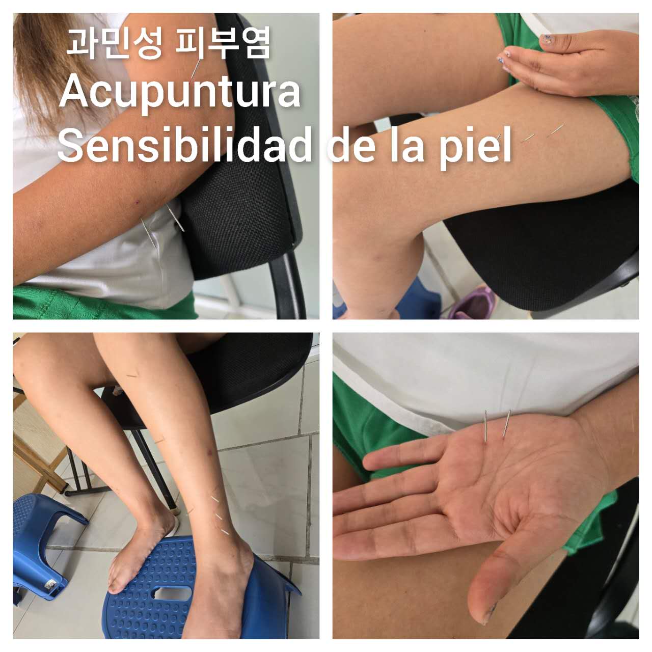 过敏性皮肤炎.jpg