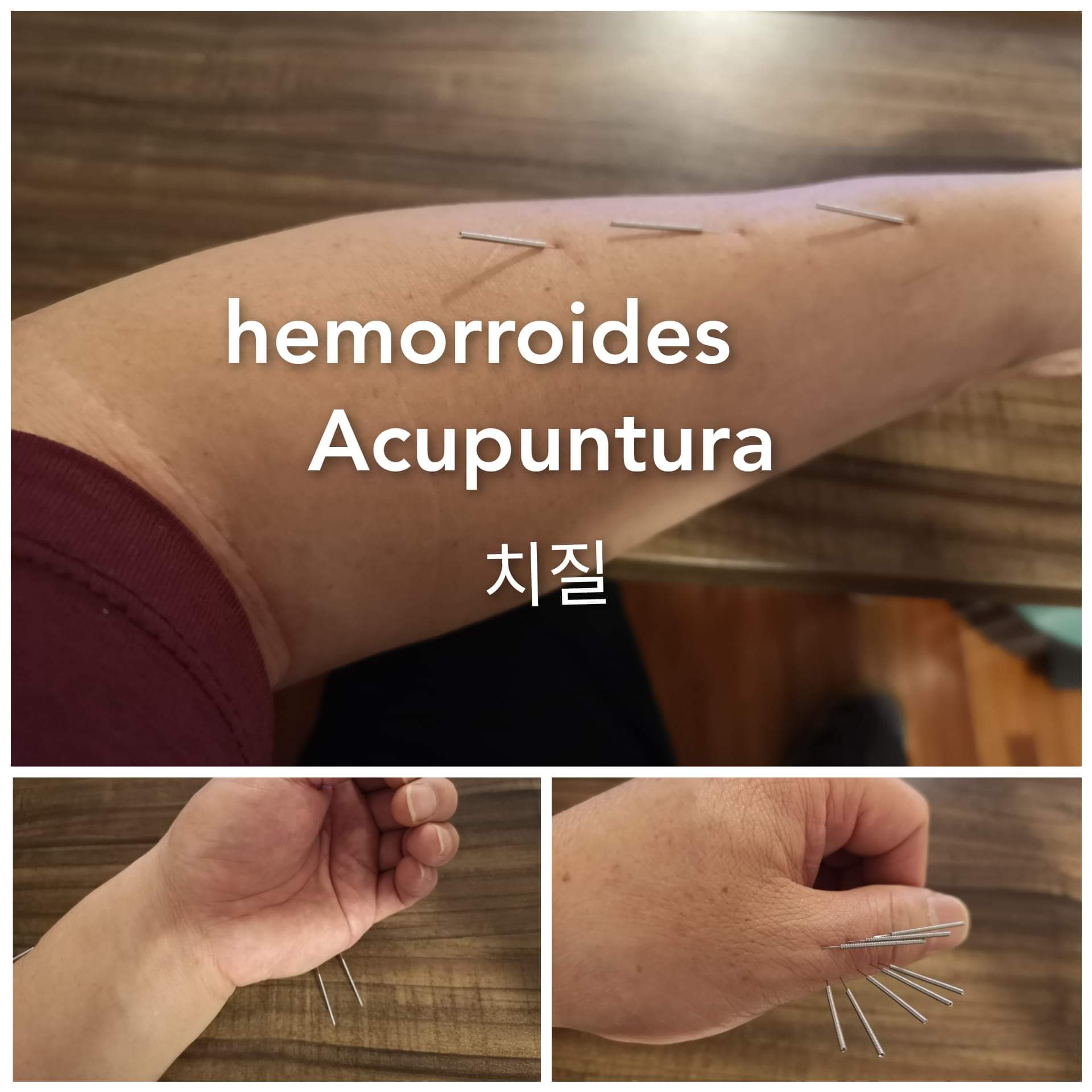 痔疮.jpg