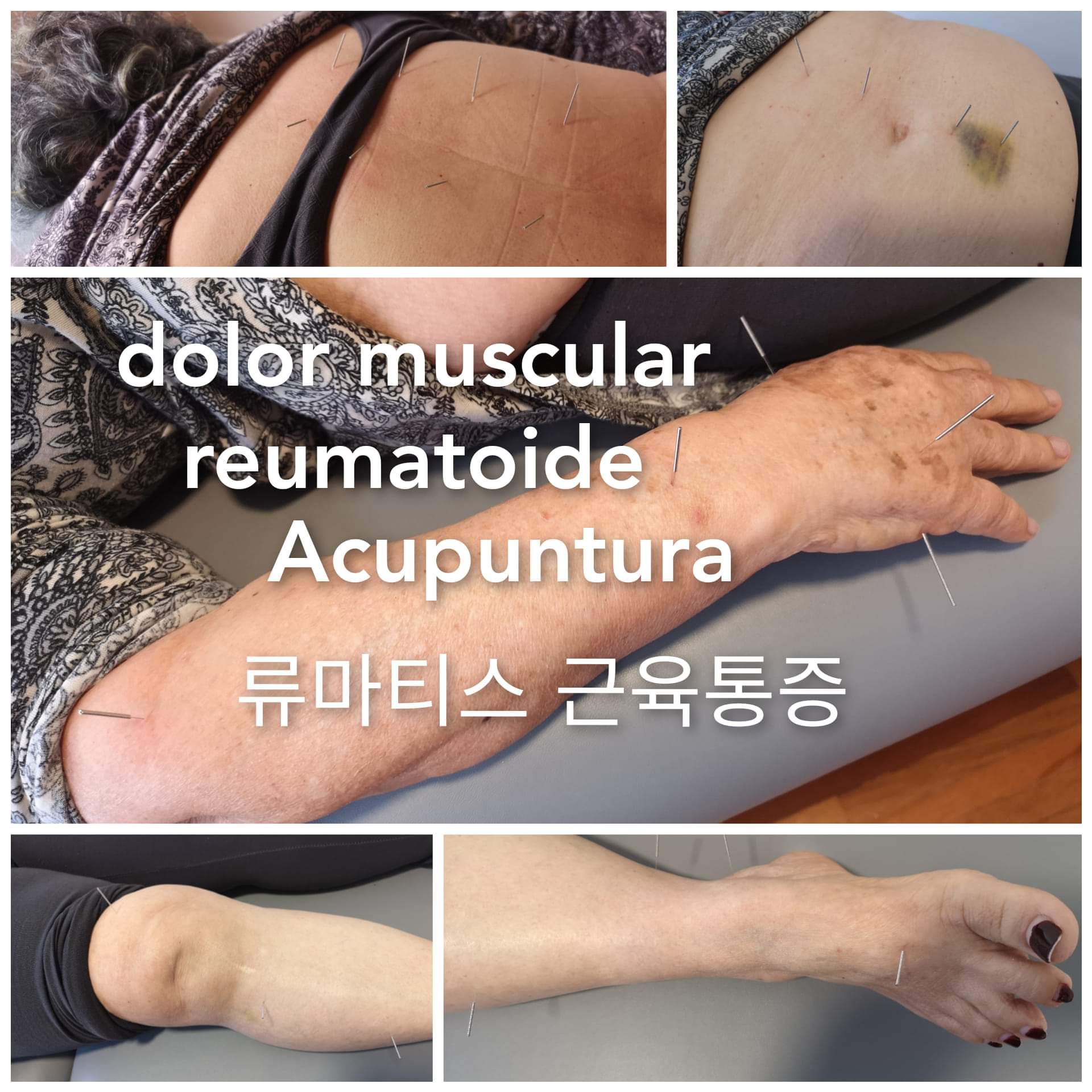 类风湿肌肉疼痛.jpg