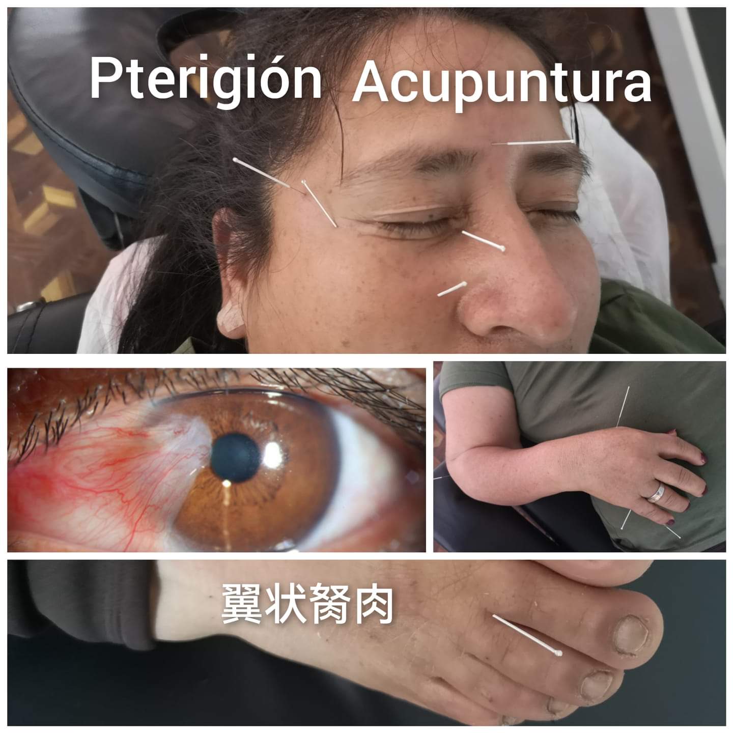 翼状胬肉.jpg