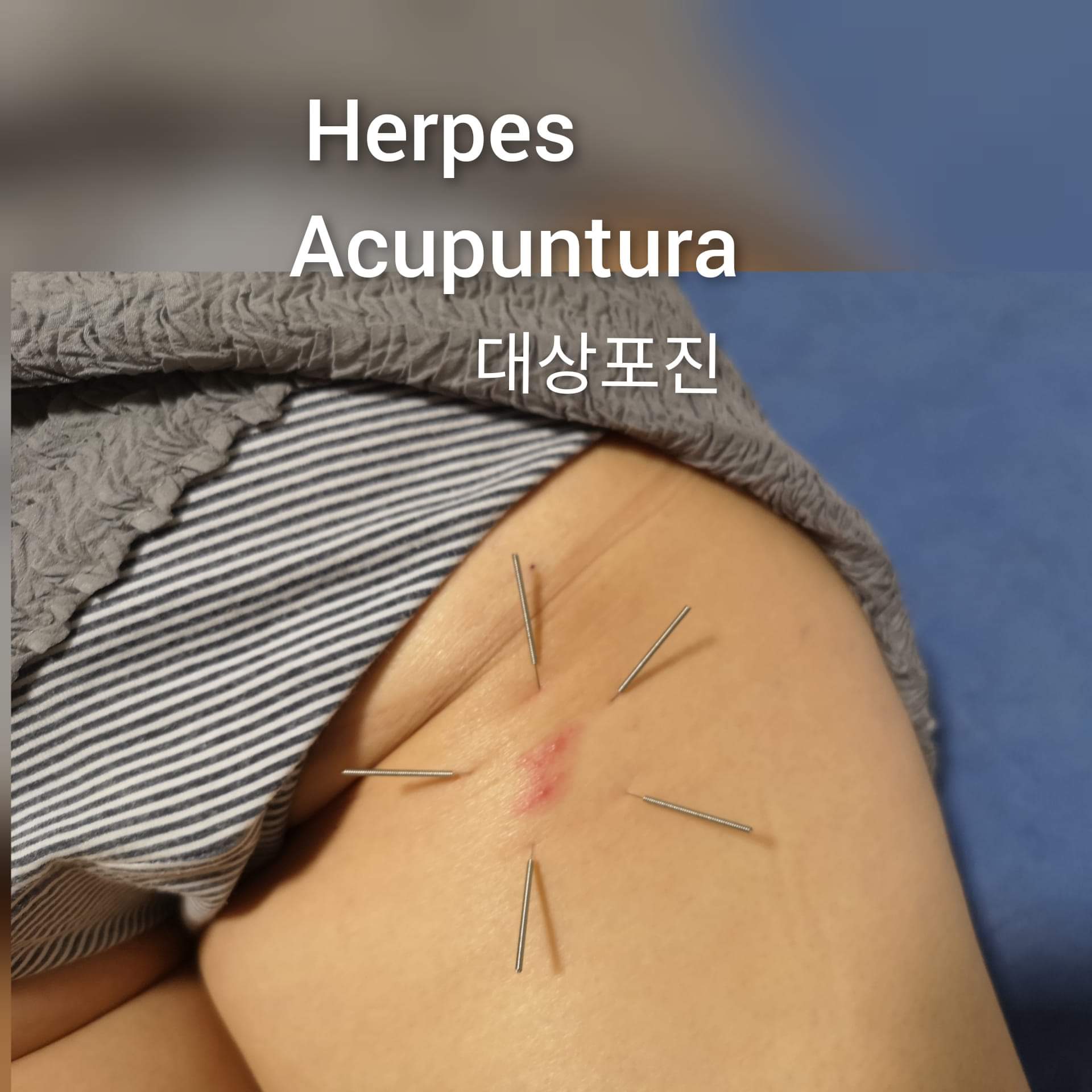 带状疱疹1.jpg
