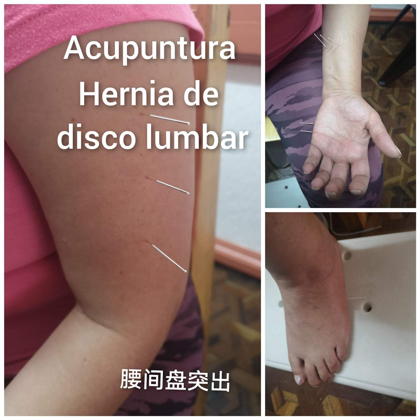 腰间盘突出3.jpg