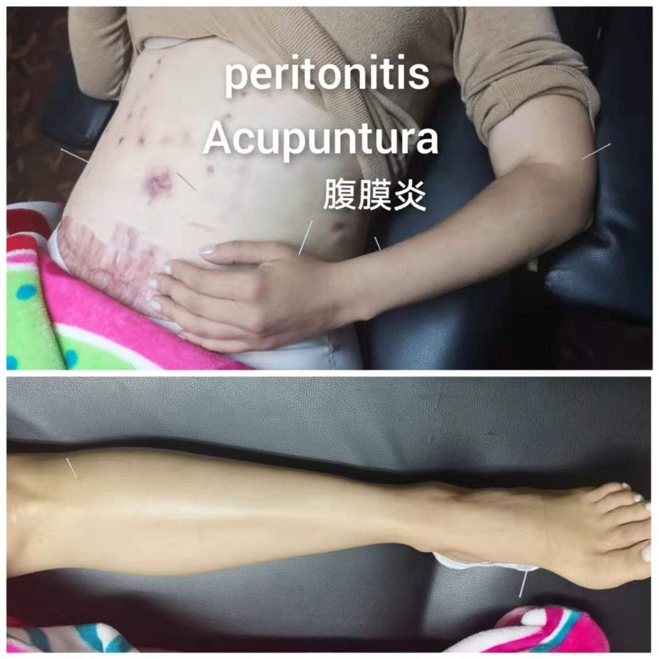 腹膜炎5.jpg