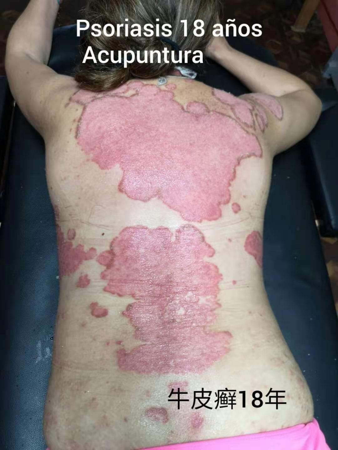 牛皮癣.jpg