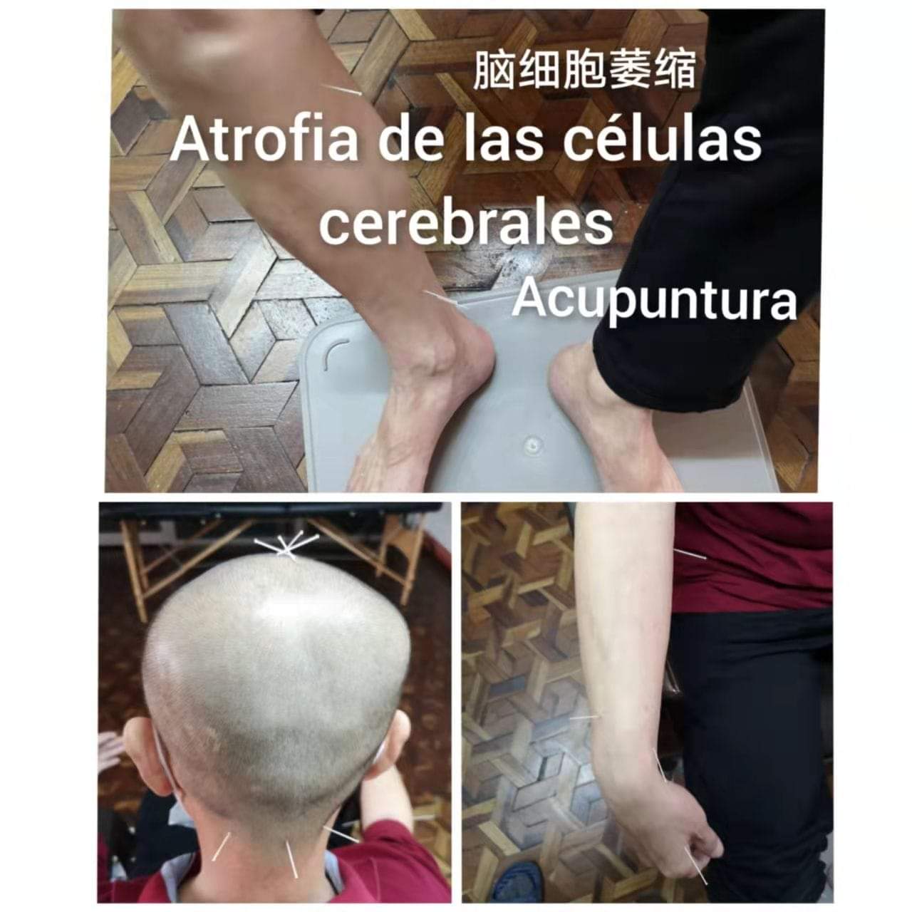 脑细胞萎缩.jpg