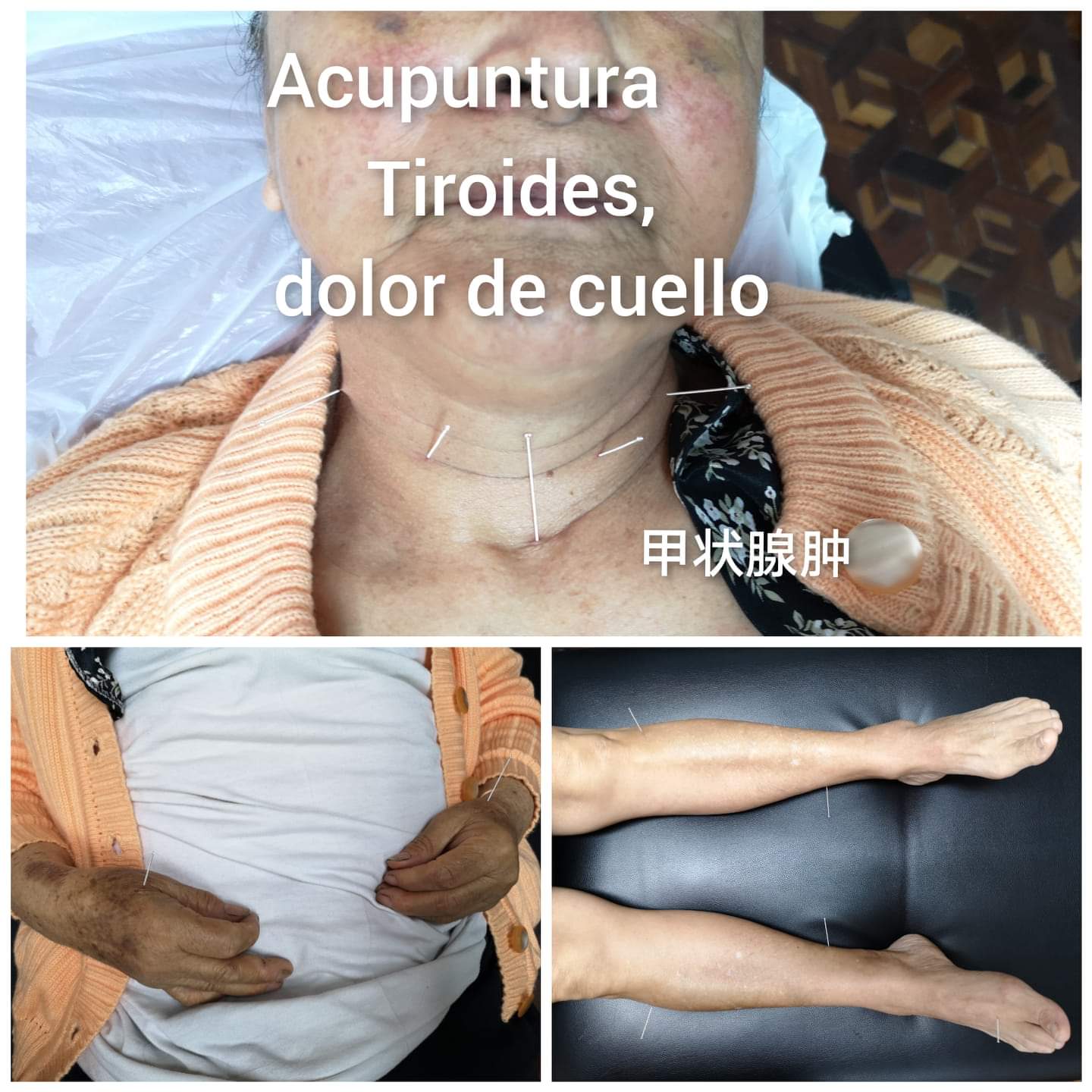 甲状腺肿4.jpg