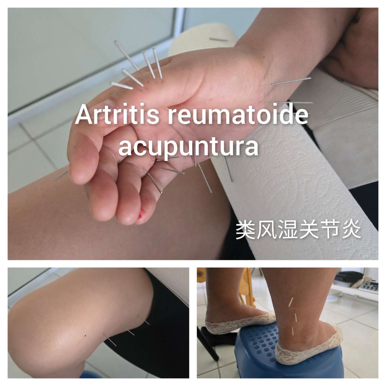 类风湿关节炎.jpg