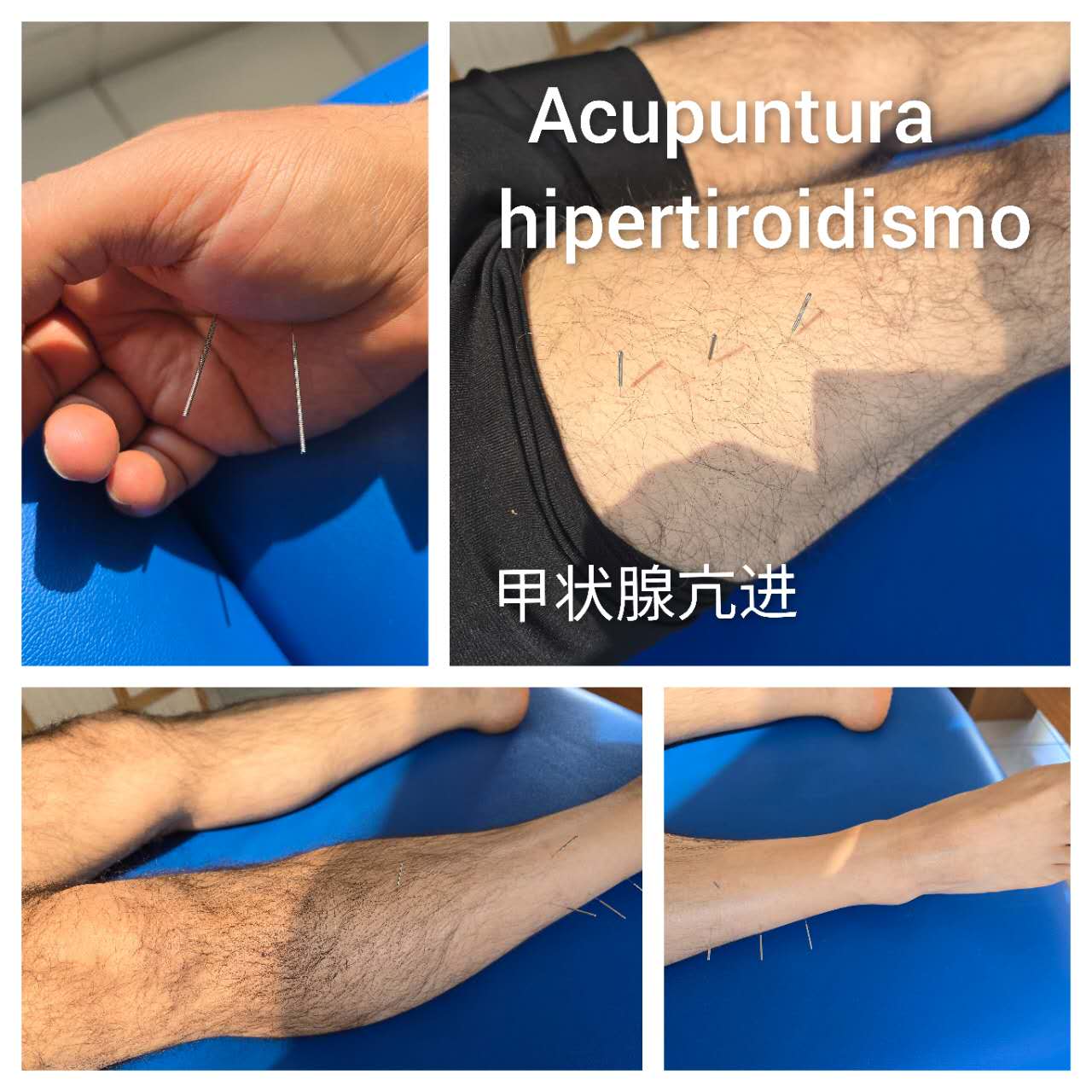 甲状腺亢进.jpg