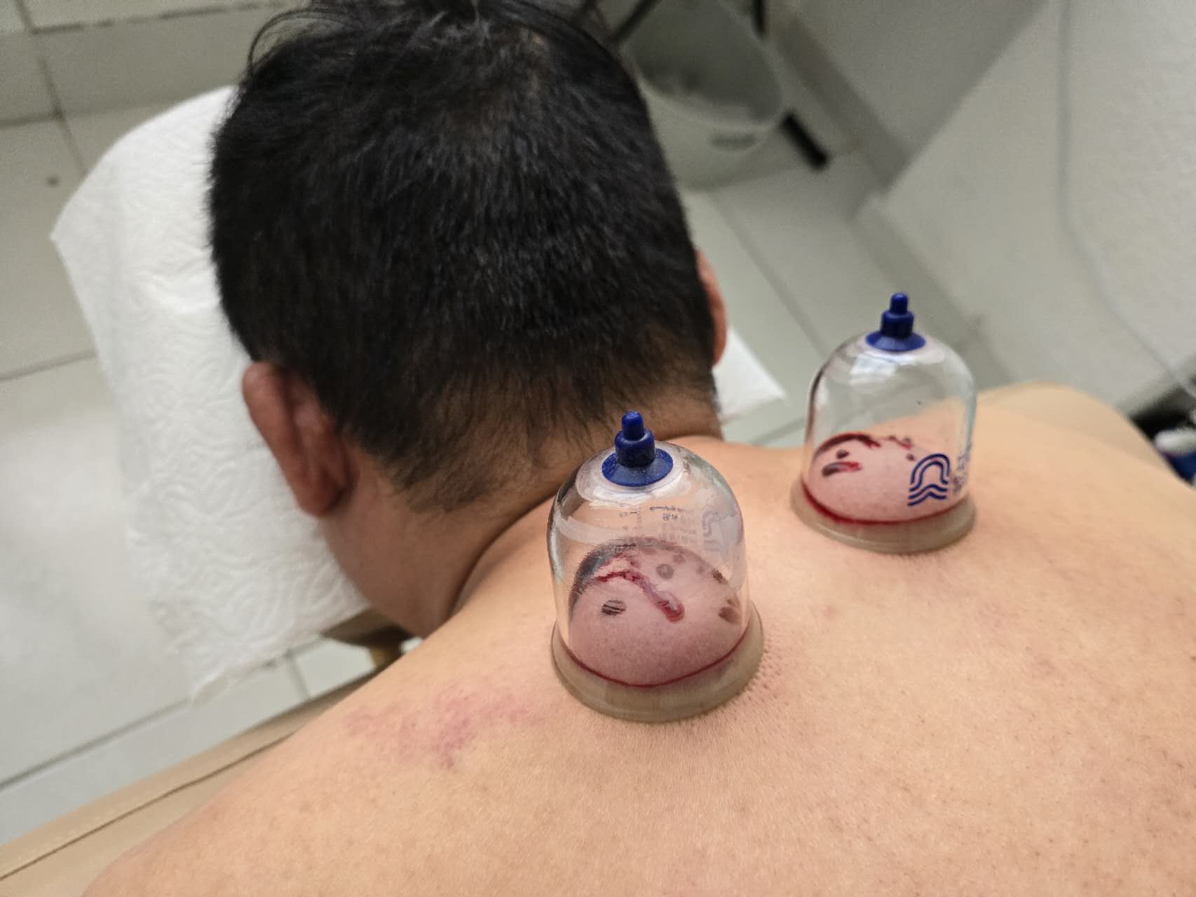 刺血治疗.jpg