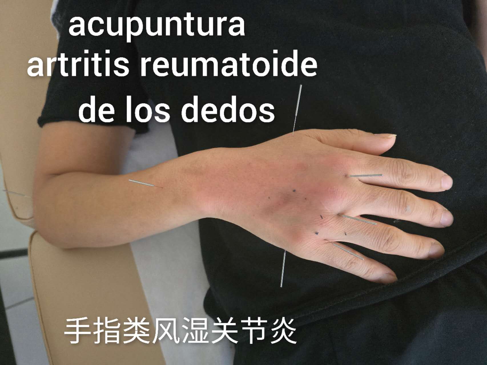 手指类风湿关节炎.jpg